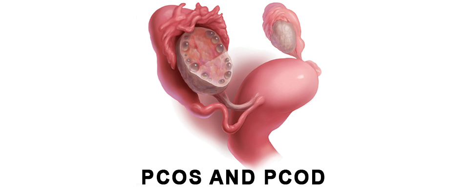What Is The Difference Between PCOS And PCOD?
