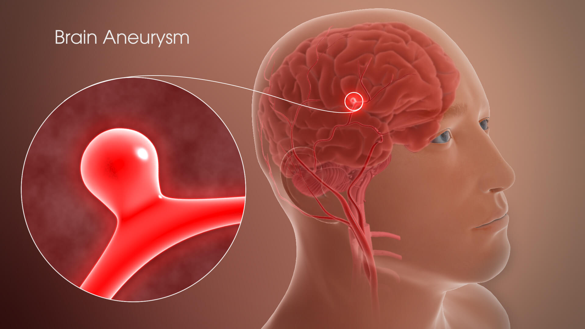 Brain Aneurysm Disease: Causes And Symptoms