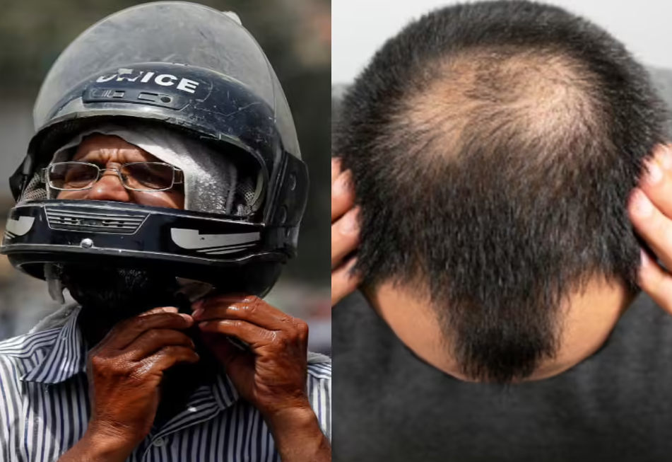Helmet and Hair Loss: Causes, Prevention