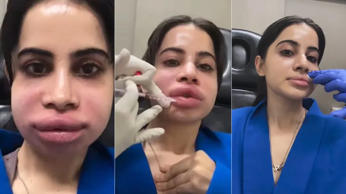 Urfi Javed Shares Painful Lip Filler Removal