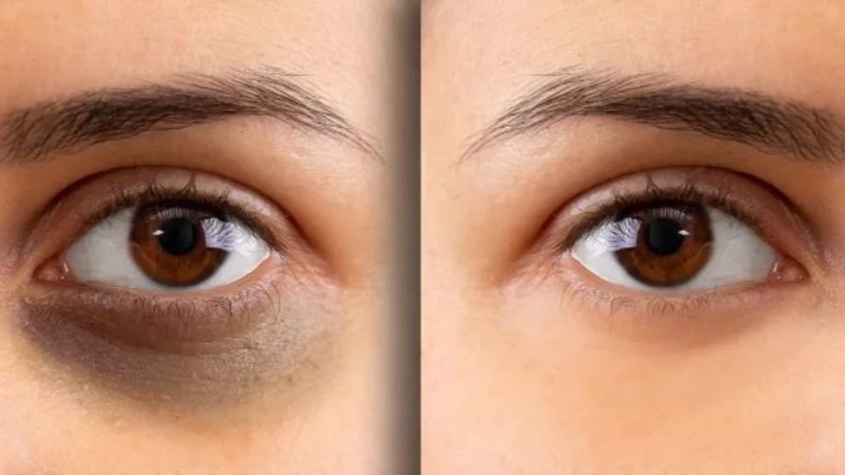 Make-up Tips: Follow These Tips To Hide Dark Circles