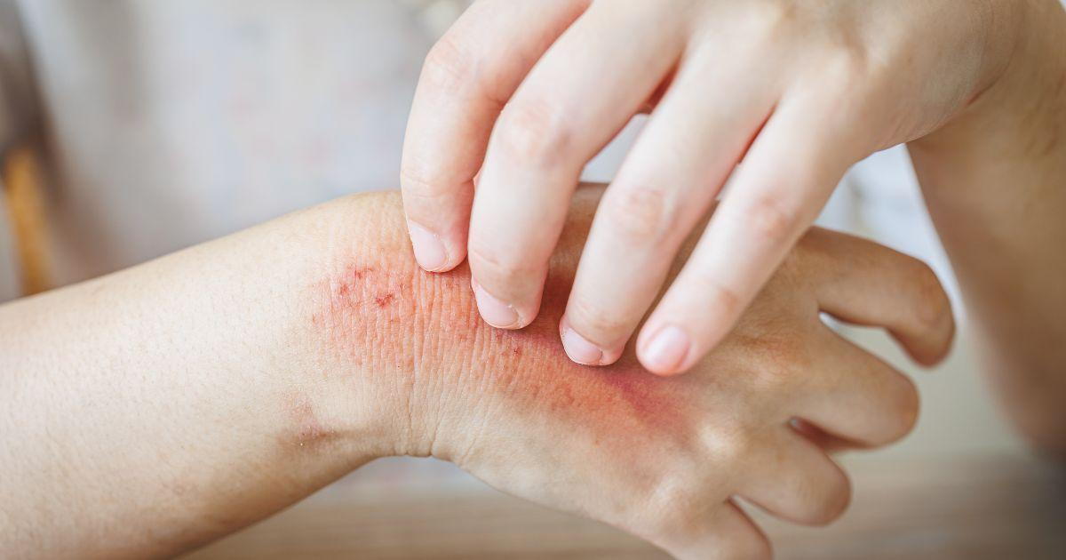 Easy Home Remedies For Fungal Infections