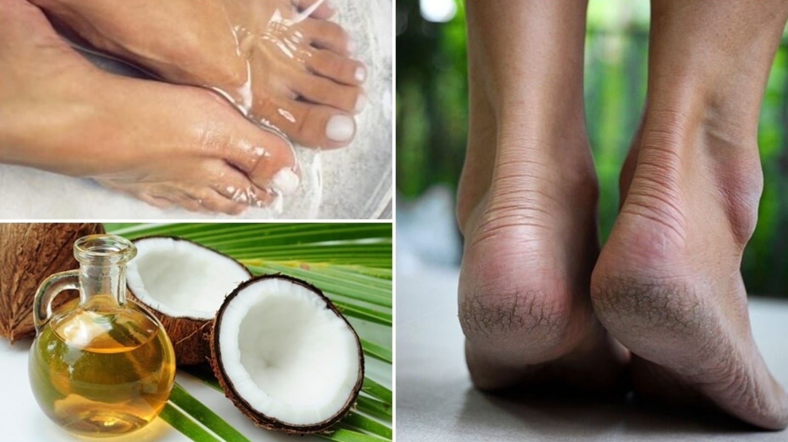 Simple Home Remedies to Heal Cracked Heels Naturally